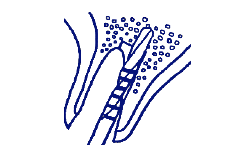 W&H Implantmed Classic Package (SI-915)