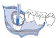 S-16 High Speed Oral Surgery Handpiece - Global Dental Shop