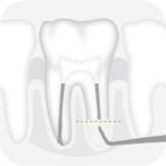 Distal Epico tip 1 - Global Dental Shop